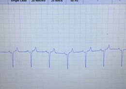 Abbildung eines EKG